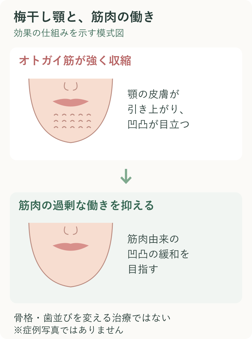 オトガイ筋の強い収縮で顎の凹凸が目立ち、過剰な働きを抑えることで緩和を目指す説明図